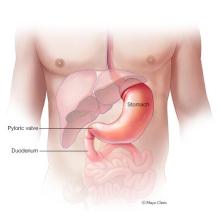 Illustration of stomach, pyloric valve and upper part of small intestine, called the duodenum