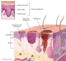 Where skin cancer develops 