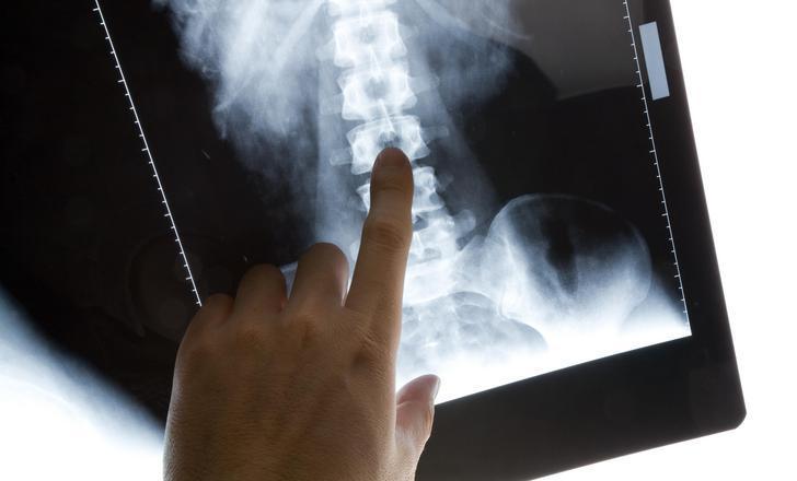 A person reviewing a spine xray.