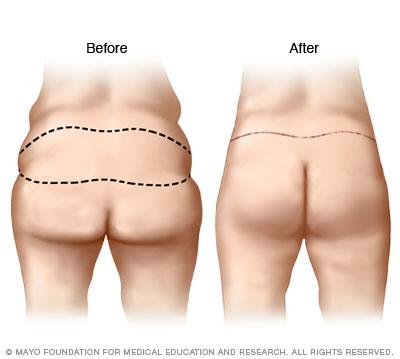 Buttocks shown before and after a buttock lift