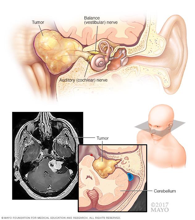 A vestibular schwannoma, a benign tumor on the nerves leading from the inner ear to the brain.