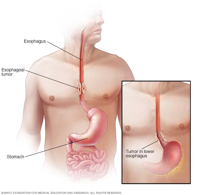 Illustration of esophageal cancer