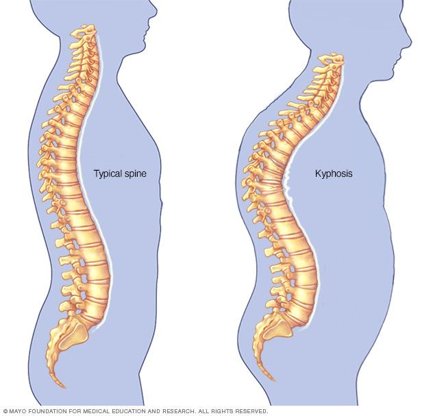 Illustration showing kyphosis