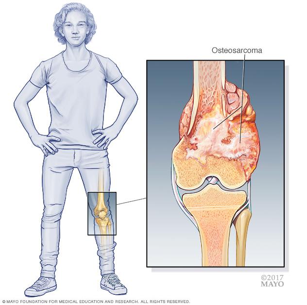 Illustration of a leg bone tumor at the knee, with an inset showing osteosarcoma growing from the end of the femur.