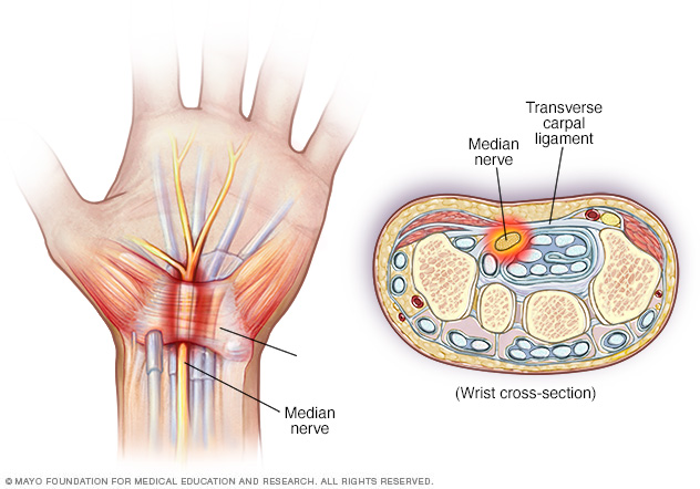 Pinched nerve in wrist