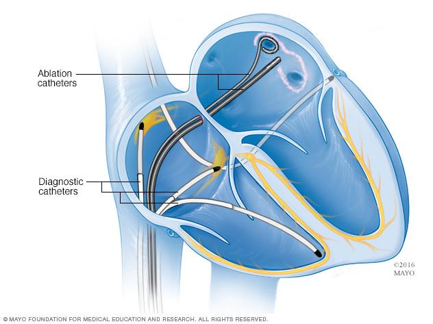 Illustration showing a type of cardiac ablation called pulmonary vein isolation