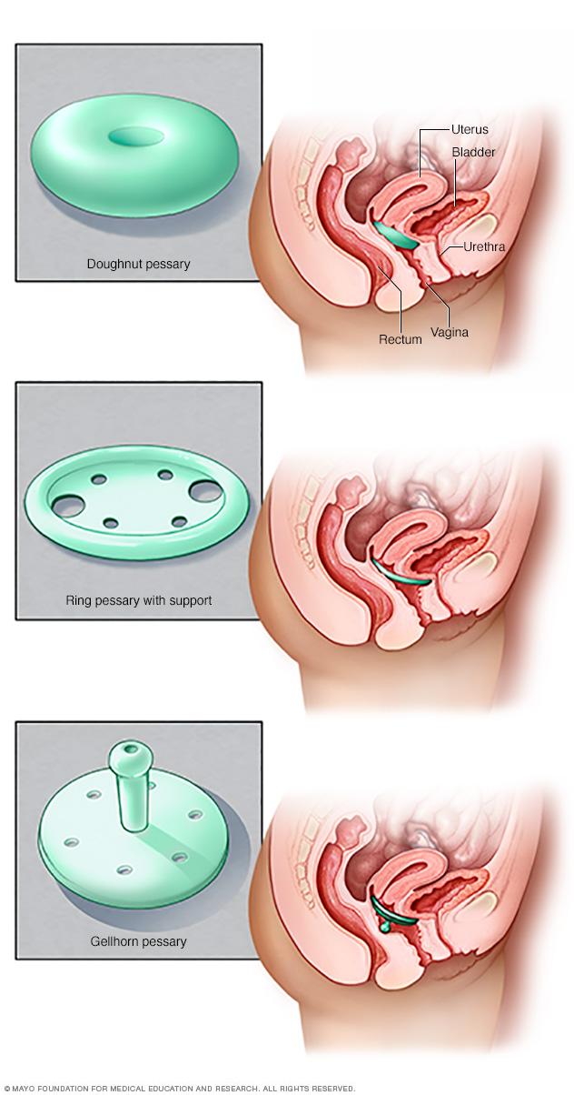 Three types of pessaries
