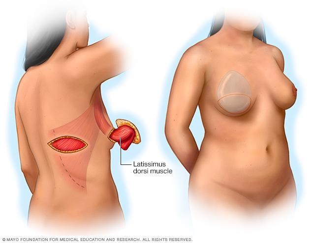 Before and after images of a pedicle lastissimus dorsi flap procedure for breast reconstruction.
