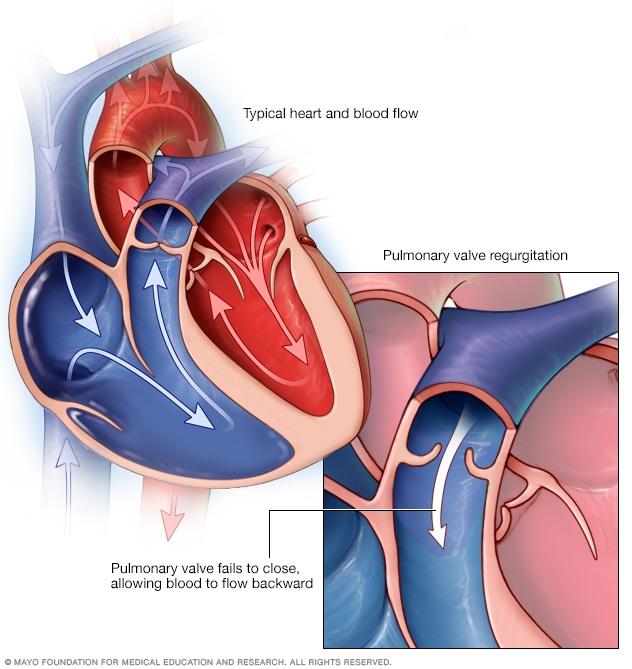 Pulmonary valve regurgitation