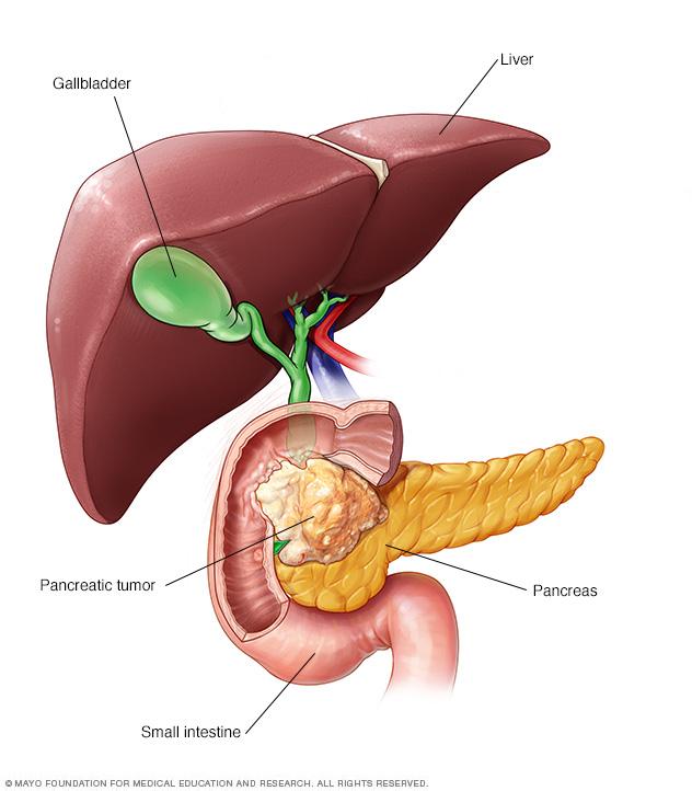 Illustration of the liver, gallbladder, pancreas, pancreatic tumor and small intestine