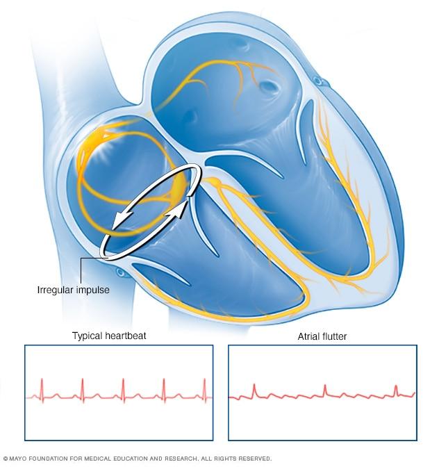 Illustration showing atrial flutter