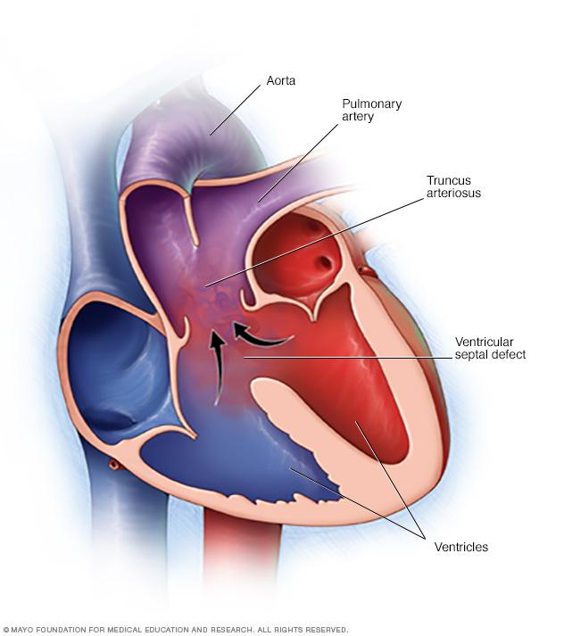 Truncus arteriosus