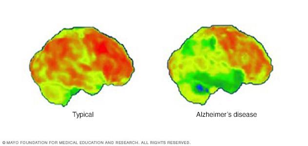 PET scan of the brain for Alzheimer's disease