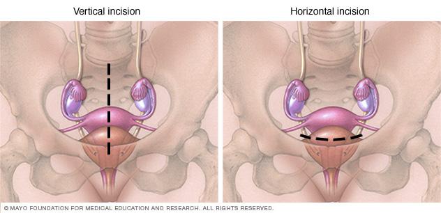 Illustration of vertical and horizontal abdominal hysterectomy incisions