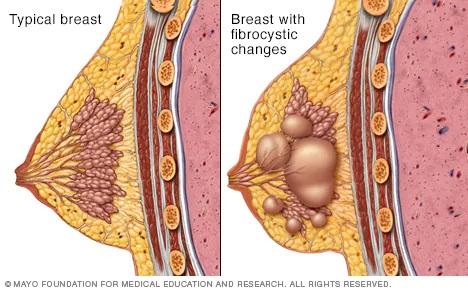 Illustration showing a breast and a fibrocystic breast
