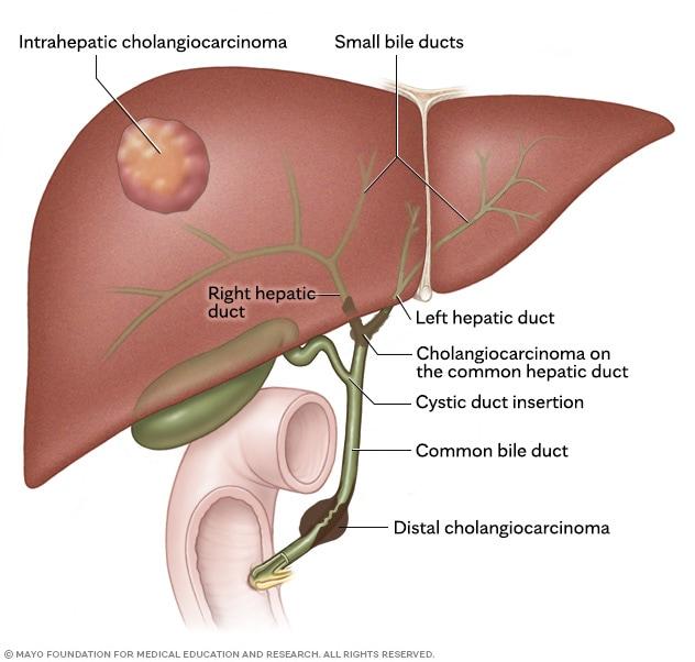 Places where cholangiocarcinoma, also called bile duct cancer, happens.
