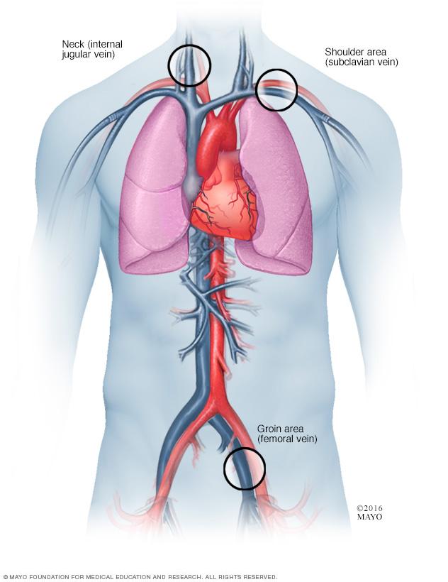 Illustration shows where catheters are inserted for cardiac ablation.