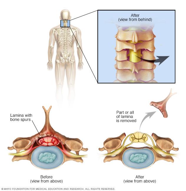 Illustration of cervical laminectomy