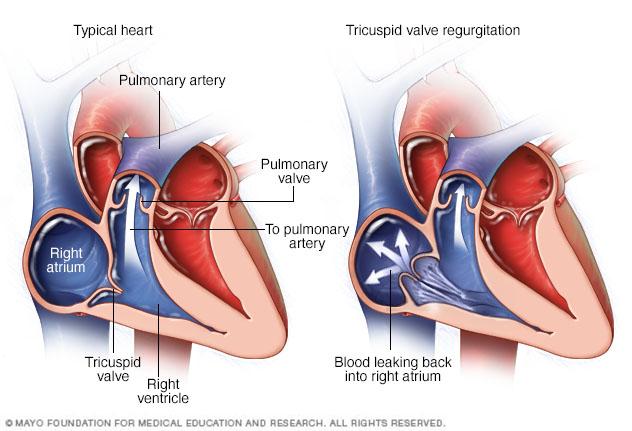 A typical heart compared with a heart showing tricuspid valve regurgitation.