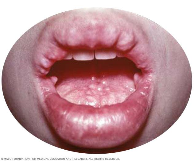 Tumors on the lips and mouth caused by multiple endocrine neoplasia, type 2B (MEN 2B)
