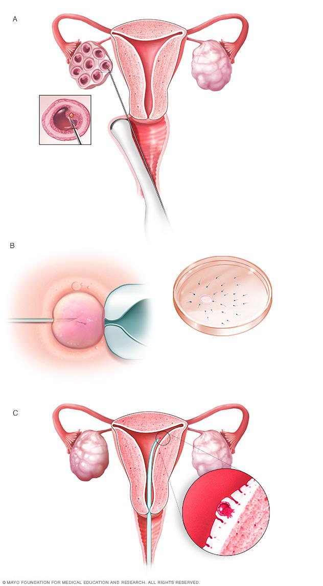 Illustration showing IVF process, including egg retrieval, fertilization and embryo transfer