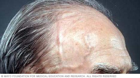 Prominent temple arteries in giant cell arteritis