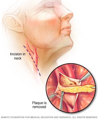 Steps in carotid endarterectomy