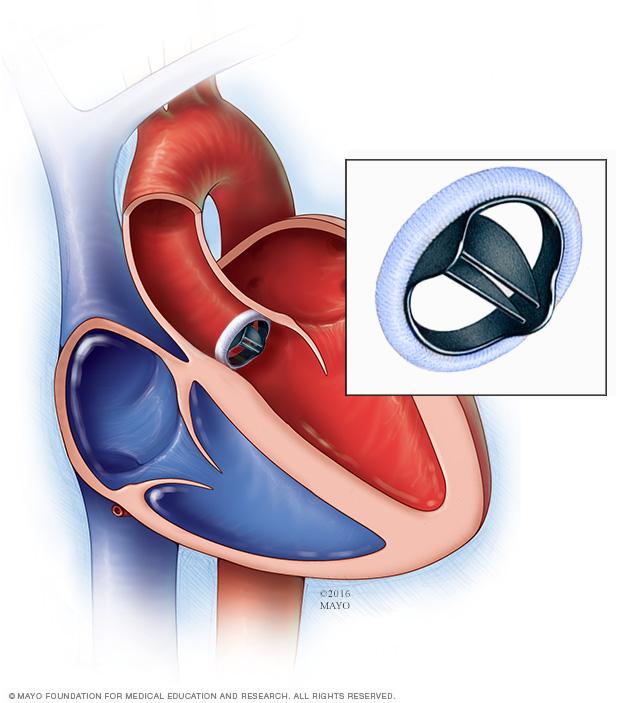 Mechanical valve replacement