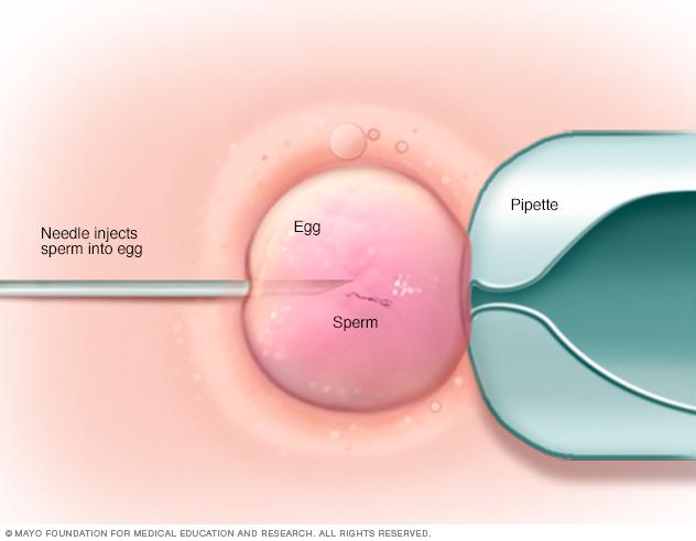 Illustration showing a single sperm injected into an egg during an ICSI procedure