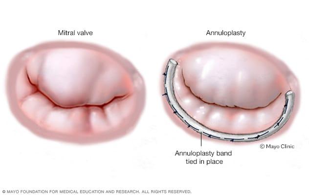 Annuloplasty