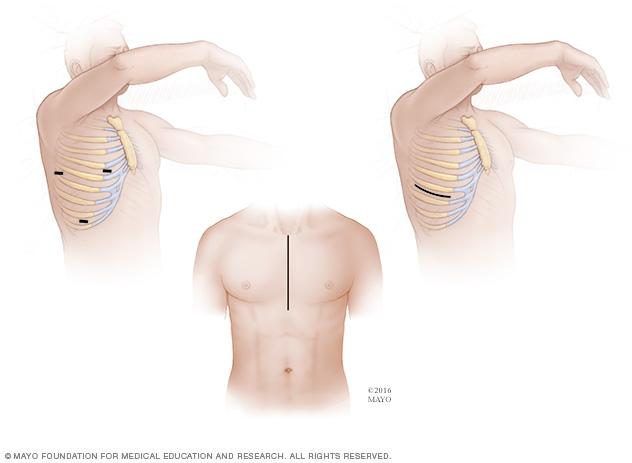 Incisions in minimally invasive and open-heart surgery