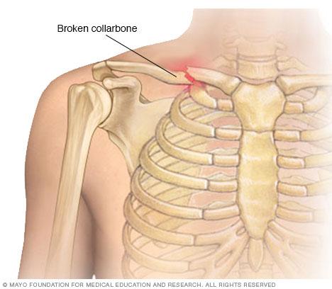 Broken collarbone