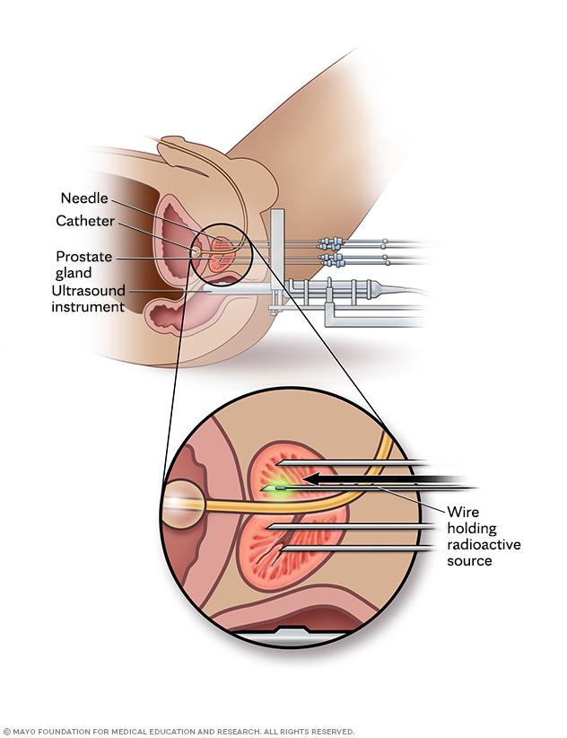 Needle delivering radioactive source into the prostate