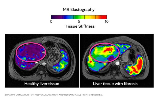 Magnetic resonance elastography images showing a healthy liver and a liver with fibrosis.