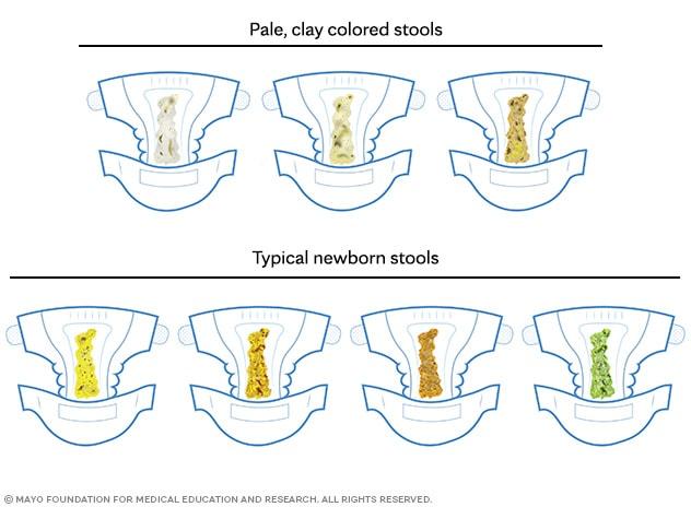 The color of typical newborn stools and pale stools seen in biliary atresia