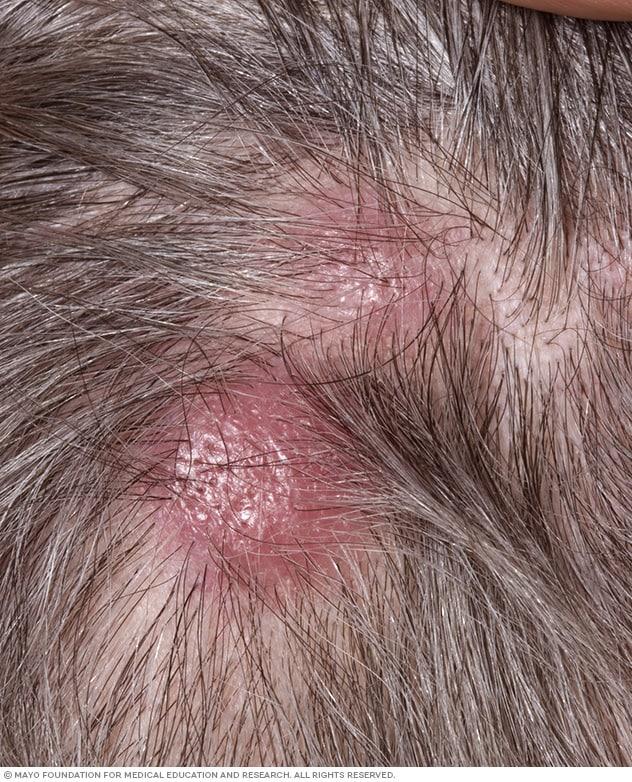 Cutaneous B-cell lymphoma on the scalp