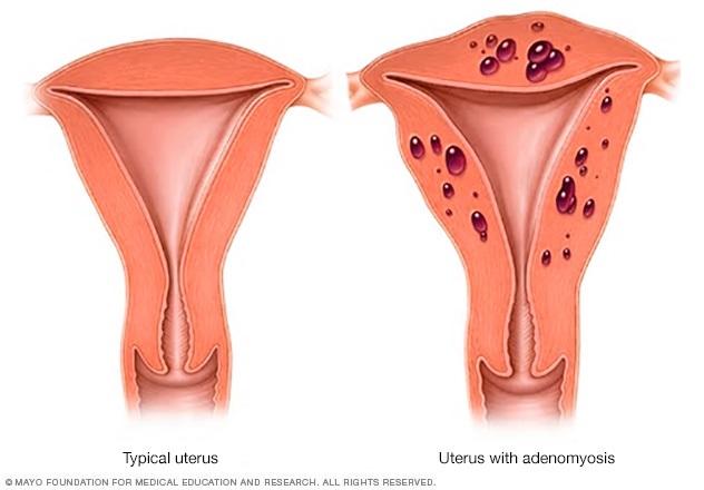 Illustration showing typical uterus vs. uterus with adenomyosis