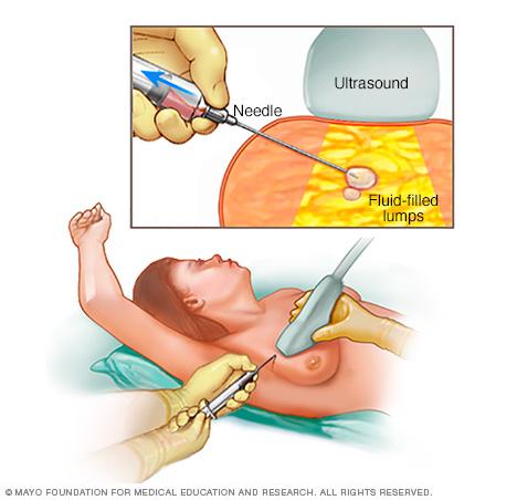 Illustration of a fine-needle aspiration of the breast