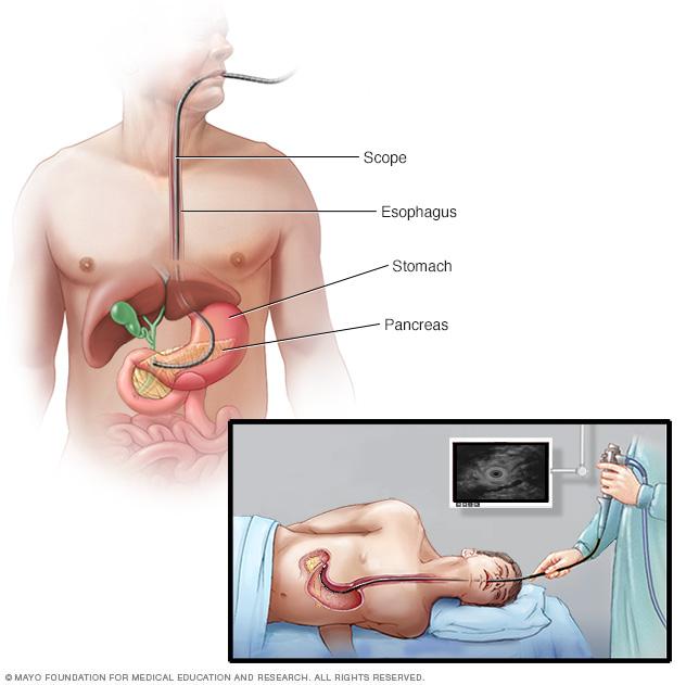 Illustration of a scope passing through the esophagus and stomach to the pancreas for an endoscopic ultrasound exam