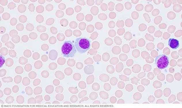 Hairy cell leukemia cells under a microscope