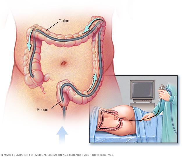 Illustration showing colonoscopy exam