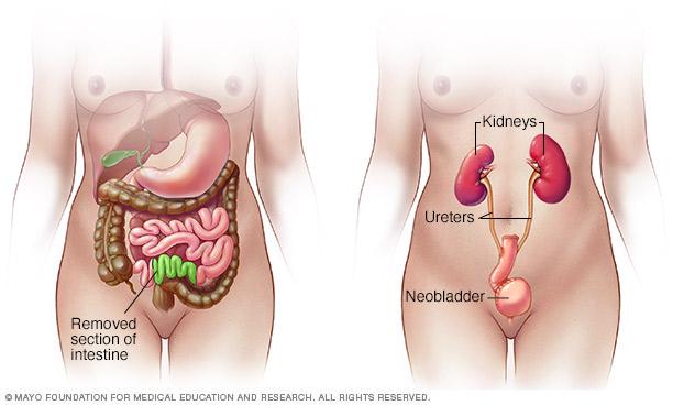 Illustration showing part of small intestine used for neobladder reconstruction 