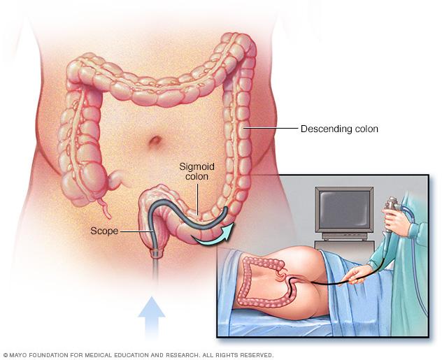 Illustration of flexible sigmoidoscopy
