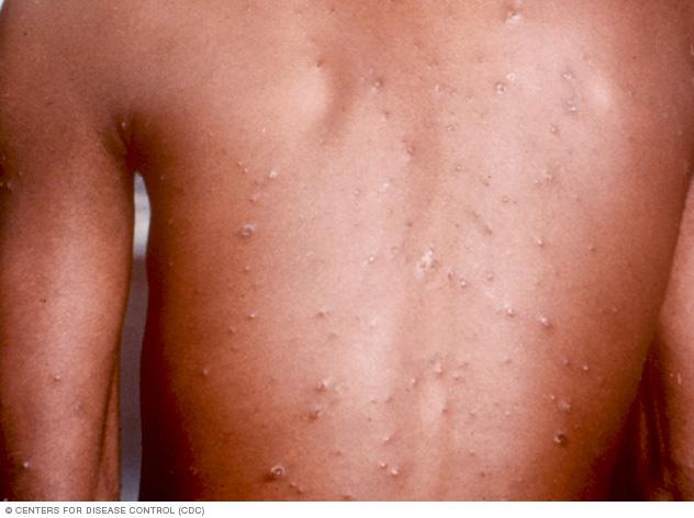 Chickenpox on brown skin