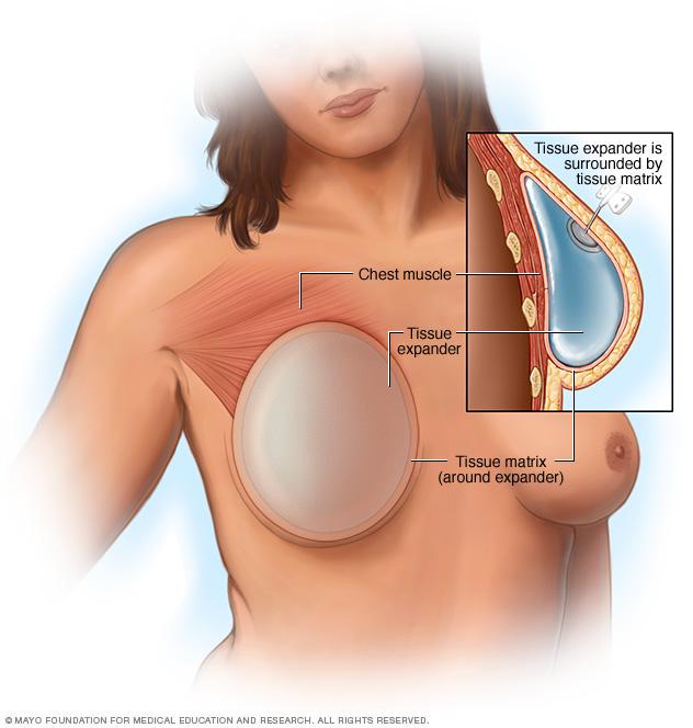 Breast reconstruction with a breast implant placed above the chest muscle