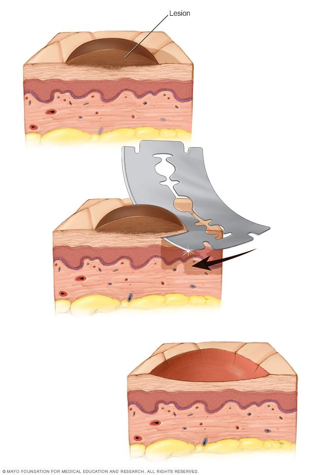 A razor is used to lift out irregular tissue. The result is a slightly indented area of skin that may heal with a scar.