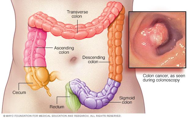 Colon cancer | Altru Health System