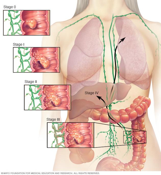 colon様 Colon cancer | Altru Health System