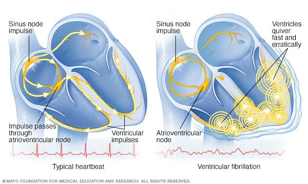 Ventricular fibrillation 