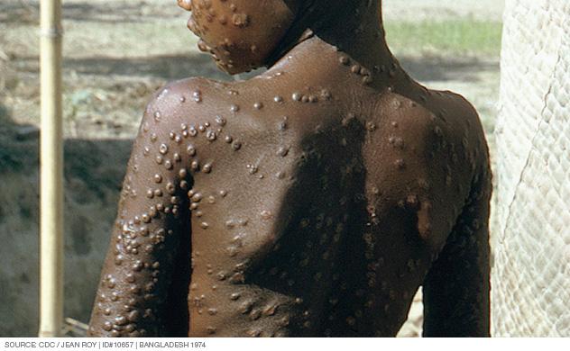 Smallpox pustules covering the trunk of the body